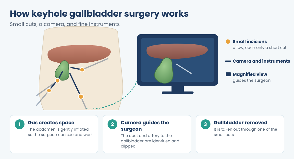 How laparoscopic gallbladder surgery works: small incisions, a camera and instruments guided by a magnified view